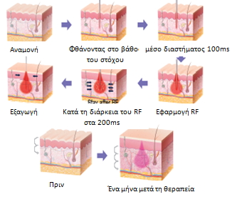 thermolift-3