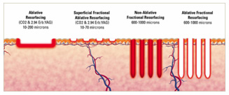 fractional-laser-co2-2