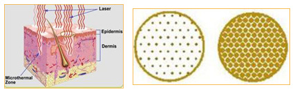 fractional-laser-co2-3